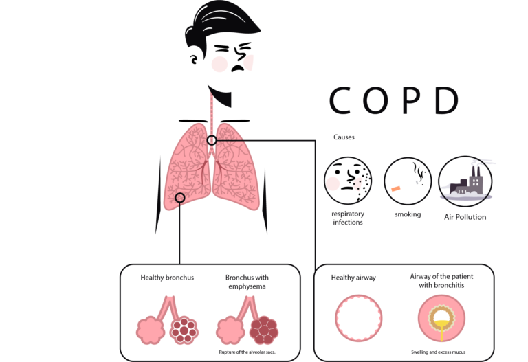 copd specialist